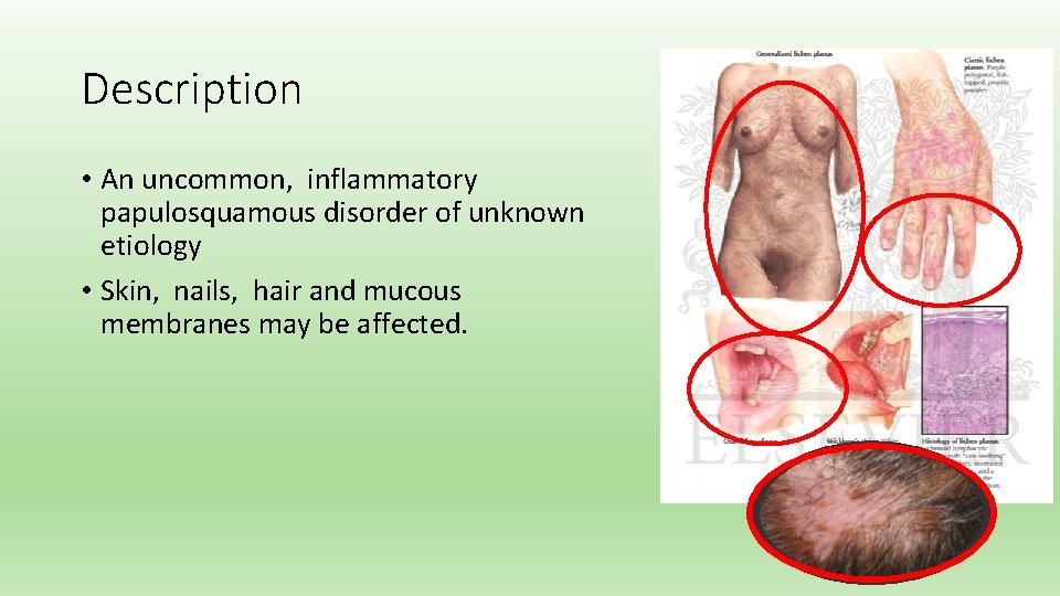 Description • An uncommon, inflammatory papulosquamous disorder of unknown etiology • Skin, nails, hair