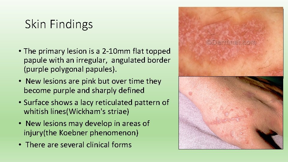 Skin Findings • The primary lesion is a 2 -10 mm flat topped papule