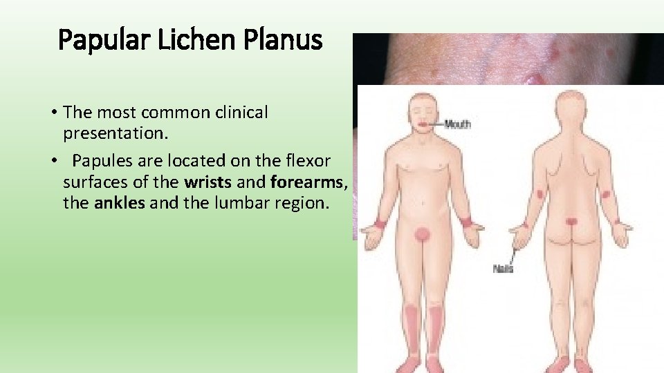 Papular Lichen Planus • The most common clinical presentation. • Papules are located on