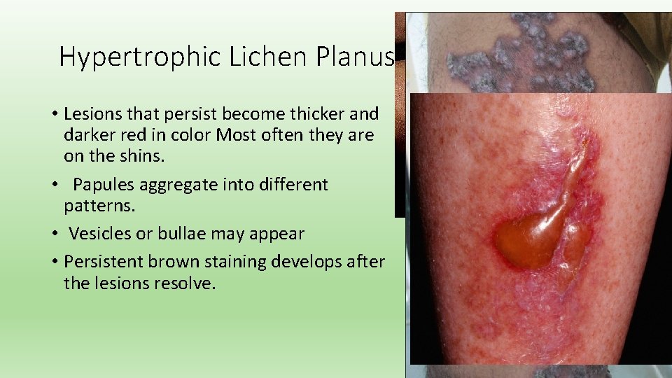 Hypertrophic Lichen Planus • Lesions that persist become thicker and darker red in color