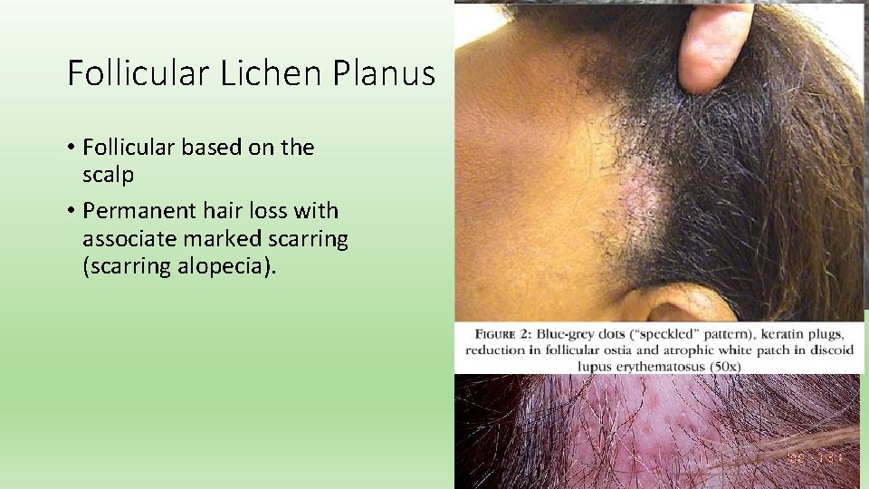 Follicular Lichen Planus • Follicular based on the scalp • Permanent hair loss with