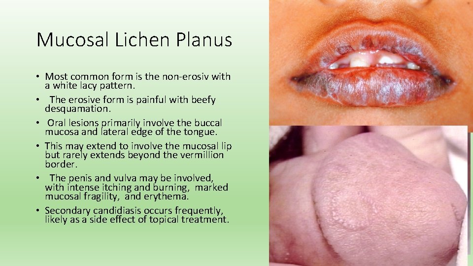 Mucosal Lichen Planus • Most common form is the non-erosiv with a white lacy