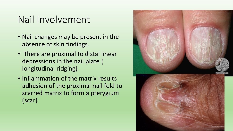 Nail Involvement • Nail changes may be present in the absence of skin findings.