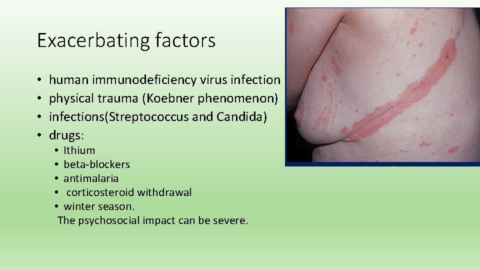 Exacerbating factors • • human immunodeficiency virus infection physical trauma (Koebner phenomenon) infections(Streptococcus and