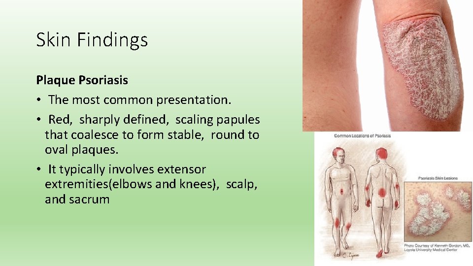 Skin Findings Plaque Psoriasis • The most common presentation. • Red, sharply defined, scaling