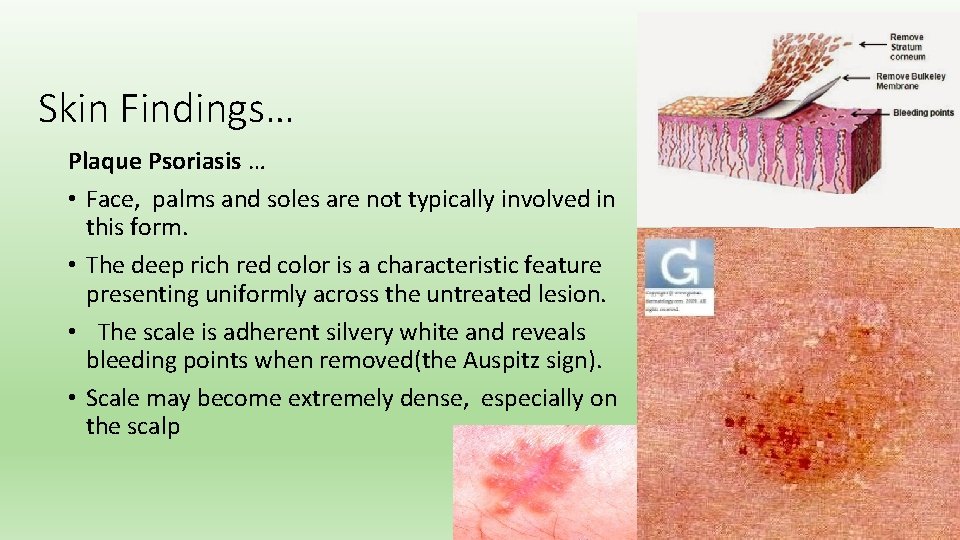 Skin Findings… Plaque Psoriasis … • Face, palms and soles are not typically involved