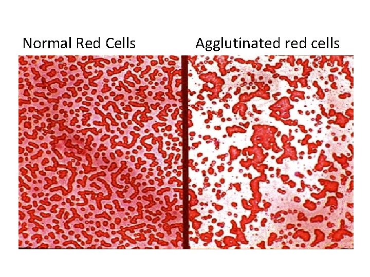 Normal Red Cells Agglutinated red cells 