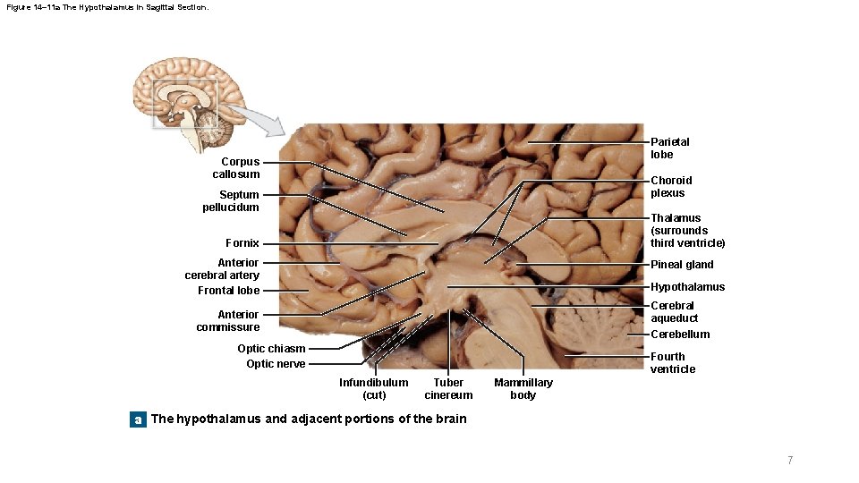 Figure 14– 11 a The Hypothalamus in Sagittal Section. Parietal lobe Corpus callosum Choroid Figure 14– 11 a The Hypothalamus in Sagittal Section. Parietal lobe Corpus callosum Choroid