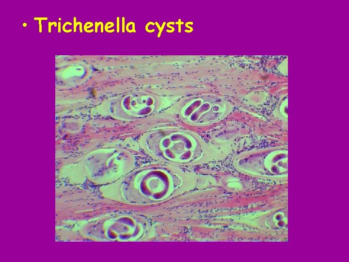  • Trichenella cysts 