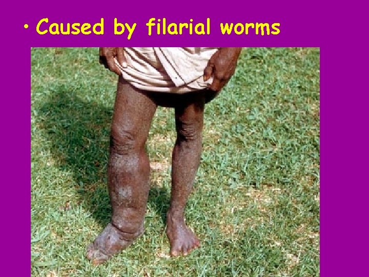  • Caused by filarial worms 