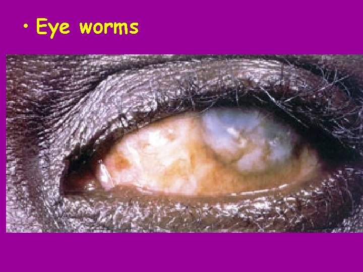  • Eye worms 