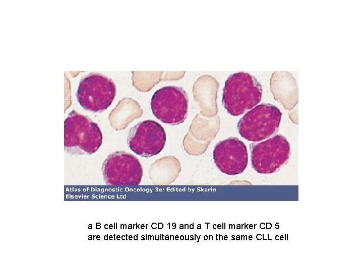 a B cell marker CD 19 and a T cell marker CD 5 are