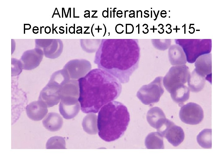 AML az diferansiye: Peroksidaz(+), CD 13+33+15 - 