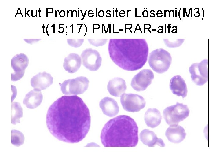 Akut Promiyelositer Lösemi(M 3) t(15; 17) PML-RAR-alfa 