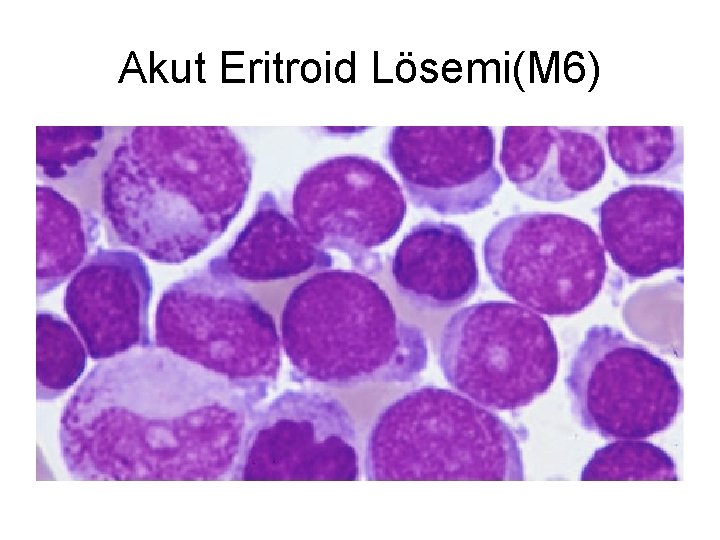 Akut Eritroid Lösemi(M 6) 