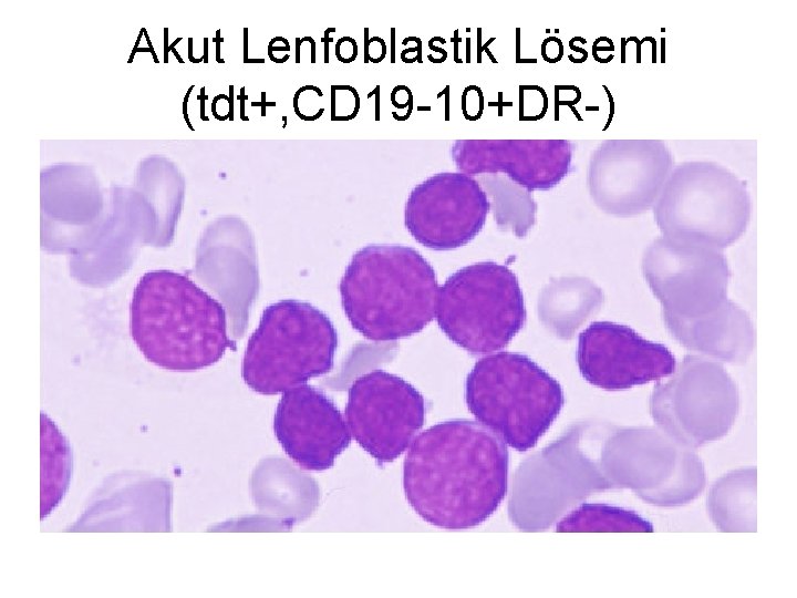 Akut Lenfoblastik Lösemi (tdt+, CD 19 -10+DR-) 