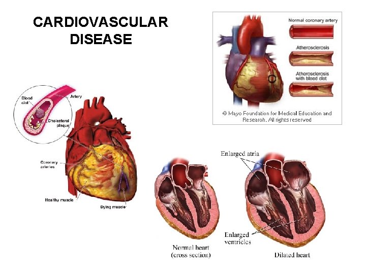 CARDIOVASCULAR DISEASE 