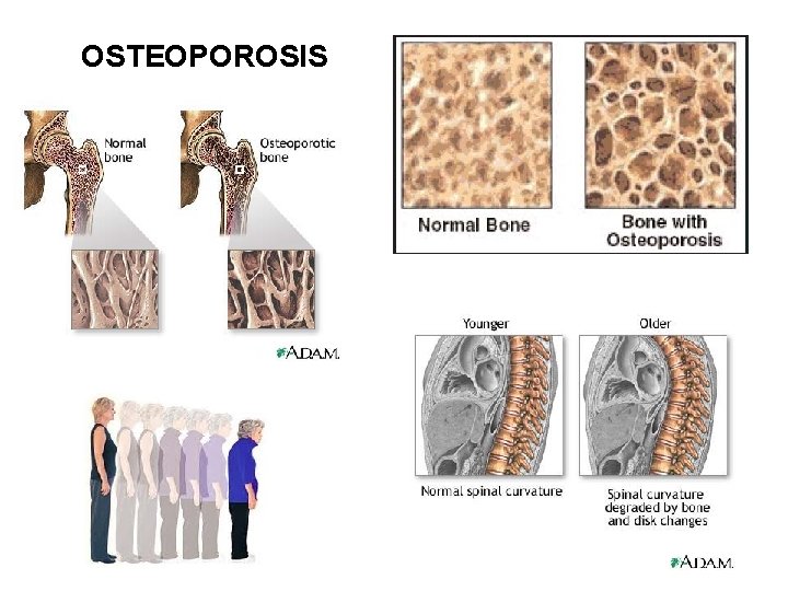 OSTEOPOROSIS 