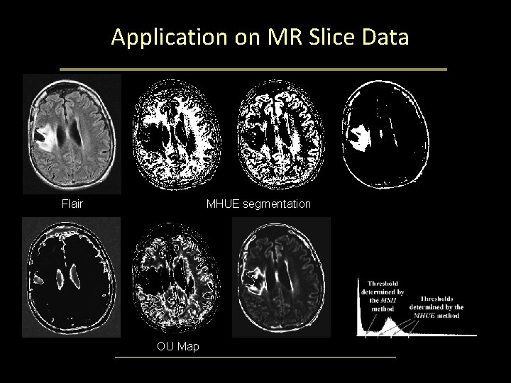 Application on MR Slice Data Flair CT Slice MHUE segmentation MSII OU Map Application on MR Slice Data Flair CT Slice MHUE segmentation MSII OU Map