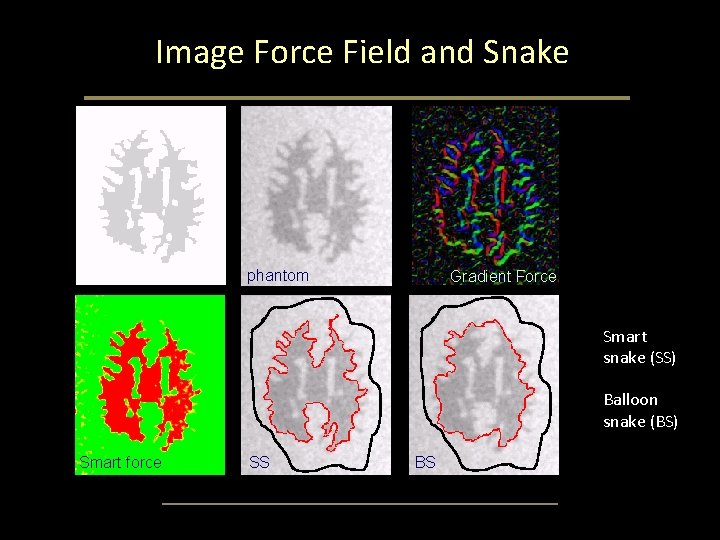 Image Force Field and Snake phantom Gradient Force Smart snake (SS) Balloon snake (BS) Image Force Field and Snake phantom Gradient Force Smart snake (SS) Balloon snake (BS)