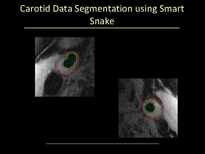 Carotid Data Segmentation using Smart Snake Carotid Data Segmentation using Smart Snake