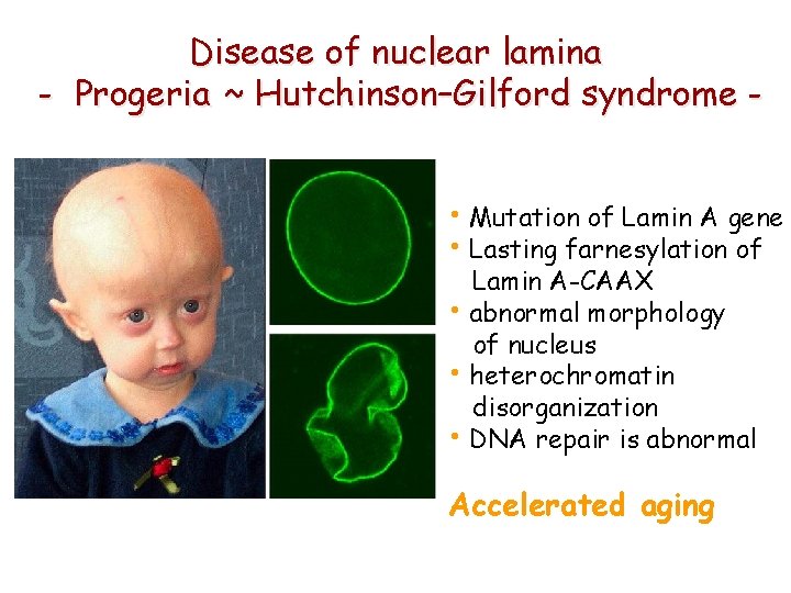Disease of nuclear lamina - Progeria ~ Hutchinson–Gilford syndrome • Mutation of Lamin A