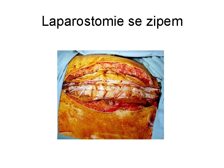 Laparostomie se zipem 