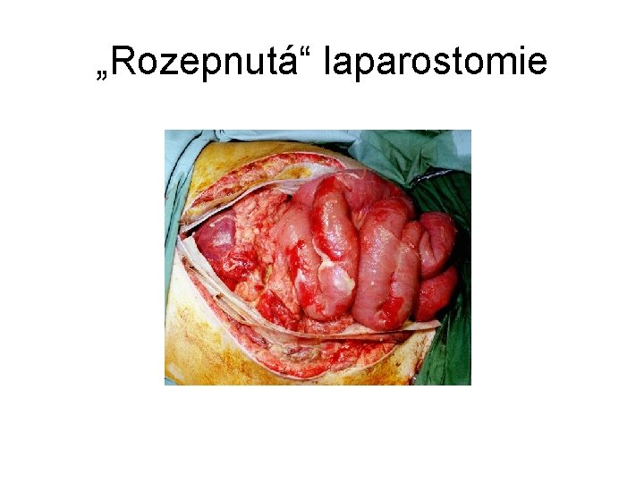 „Rozepnutá“ laparostomie 