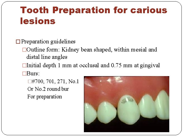 Tooth Preparation for carious lesions � Preparation guidelines �Outline form: Kidney bean shaped, within