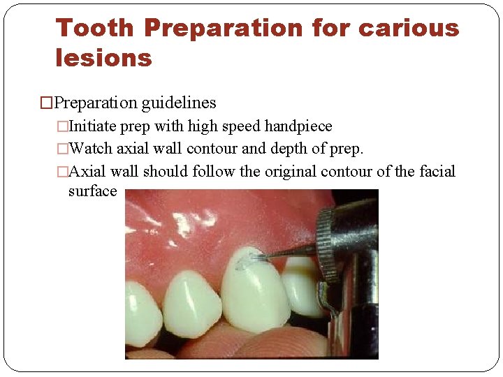 Tooth Preparation for carious lesions �Preparation guidelines �Initiate prep with high speed handpiece �Watch