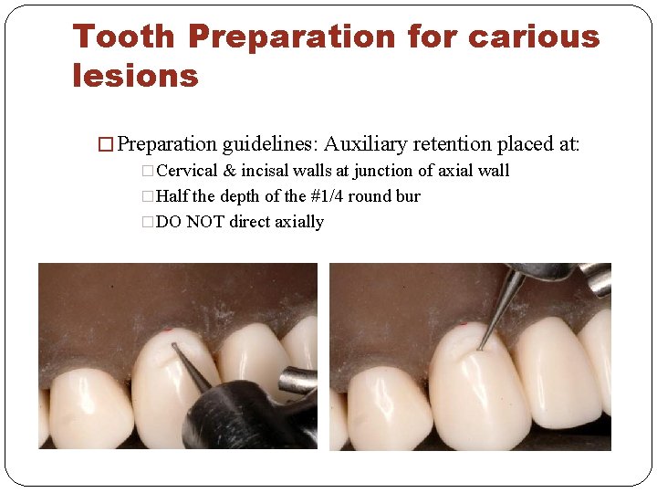 Tooth Preparation for carious lesions � Preparation guidelines: Auxiliary retention placed at: �Cervical &