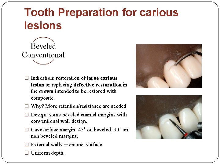 Tooth Preparation for carious lesions � Indication: restoration of large carious lesion or replacing