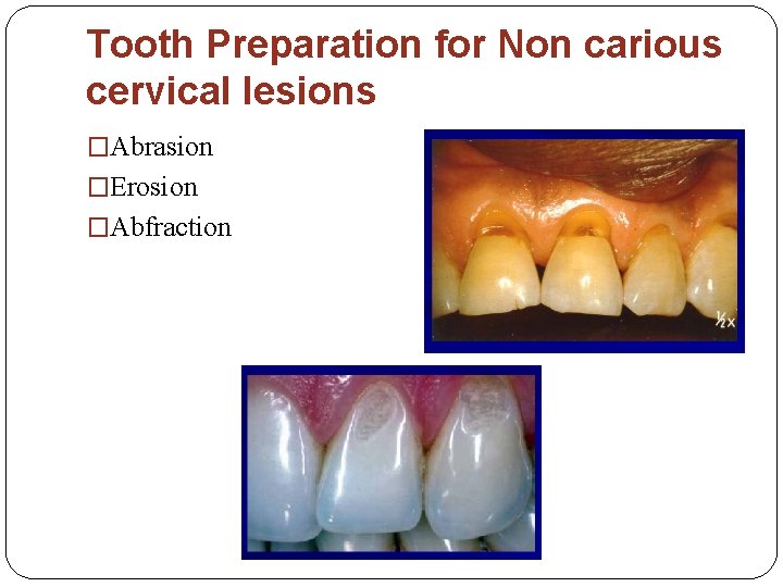 Tooth Preparation for Non carious cervical lesions �Abrasion �Erosion �Abfraction 