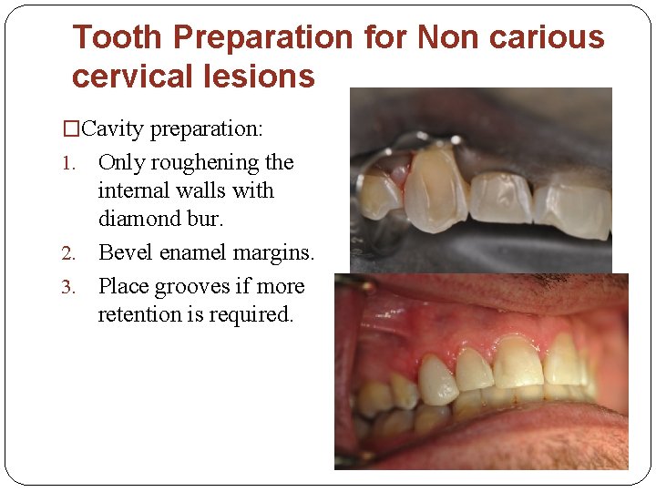 Tooth Preparation for Non carious cervical lesions �Cavity preparation: Only roughening the internal walls