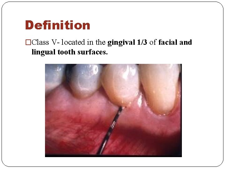 Definition �Class V- located in the gingival 1/3 of facial and lingual tooth surfaces.