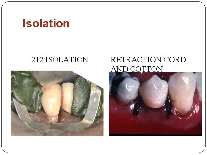 Isolation 212 ISOLATION RETRACTION CORD AND COTTON 
