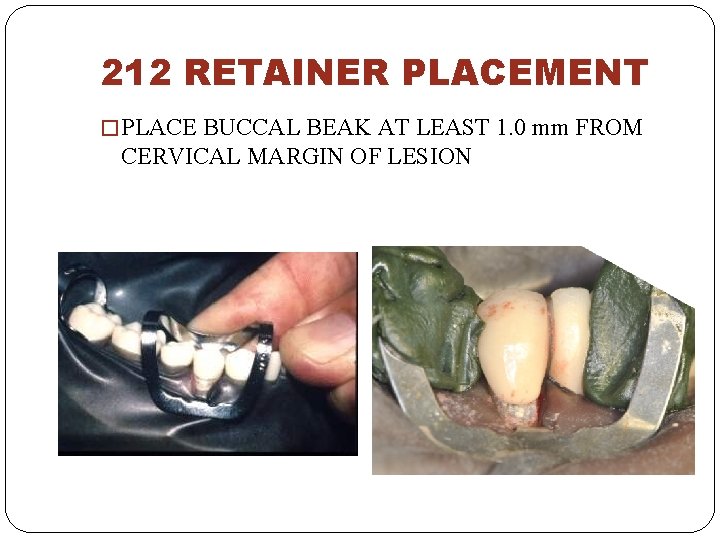 212 RETAINER PLACEMENT � PLACE BUCCAL BEAK AT LEAST 1. 0 mm FROM CERVICAL