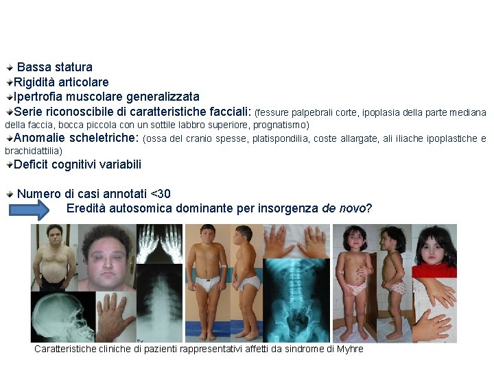 Sindrome di Myhre Bassa statura Rigidità articolare Ipertrofia muscolare generalizzata Serie riconoscibile di caratteristiche