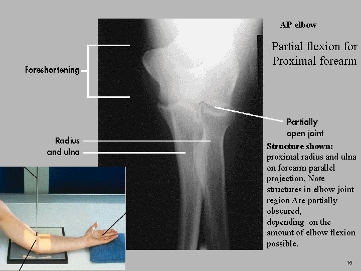 AP elbow Partial flexion for Proximal forearm Structure shown: proximal radius and ulna on