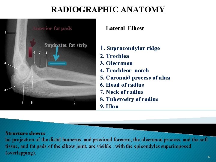 RADIOGRAPHIC ANATOMY Anterior fat pads Supinator fat strip Lateral Elbow 1. Supracondylar ridge 2.