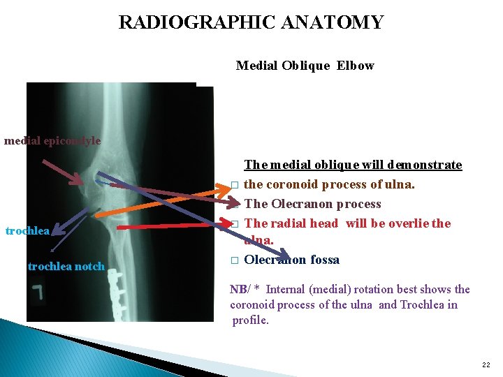 RADIOGRAPHIC ANATOMY Medial Oblique Elbow medial epicondyle trochlea notch The medial oblique will demonstrate