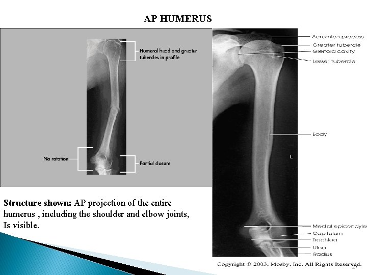 AP HUMERUS Structure shown: AP projection of the entire humerus , including the shoulder