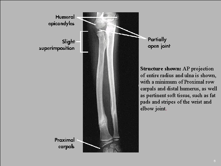 Structure shown: AP projection of entire radius and ulna is shown, with a minimum