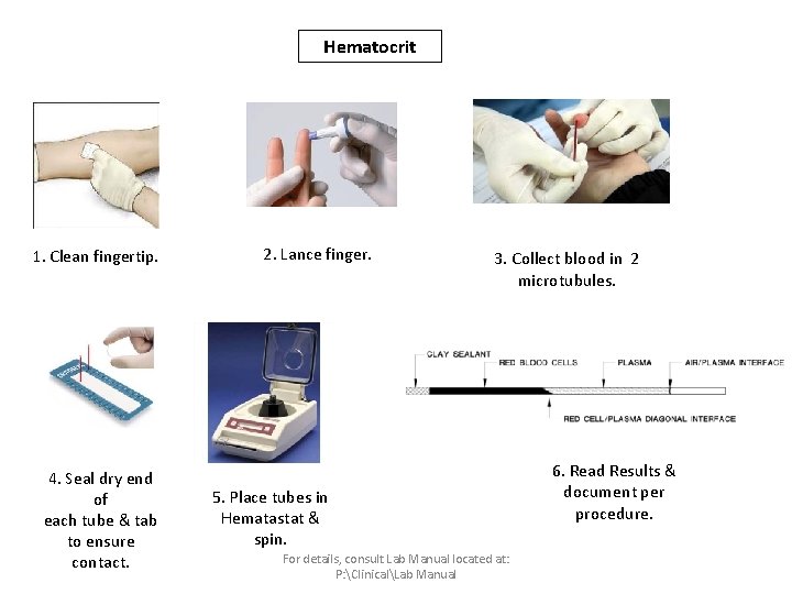 Hematocrit 1. Clean fingertip. 4. Seal dry end of each tube & tab to