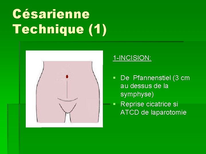 Césarienne Technique (1) 1 -INCISION: § De Pfannenstiel (3 cm au dessus de la