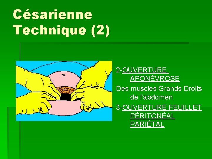 Césarienne Technique (2) 2 -OUVERTURE APONÉVROSE Des muscles Grands Droits de l’abdomen 3 -OUVERTURE