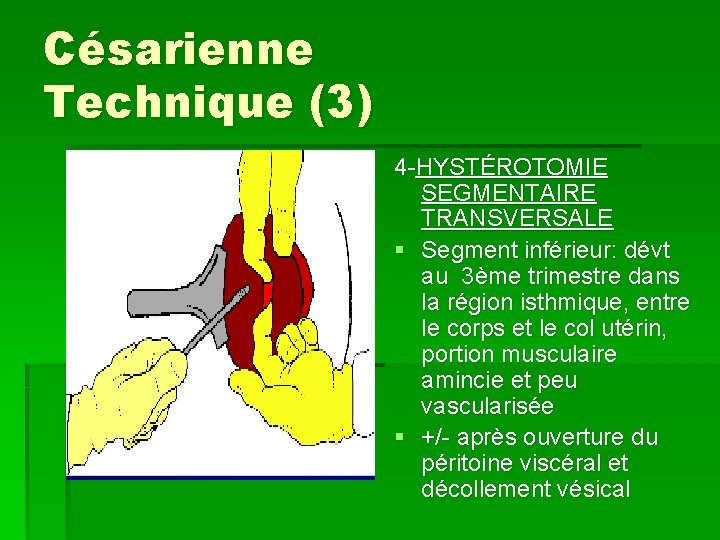 Césarienne Technique (3) 4 -HYSTÉROTOMIE SEGMENTAIRE TRANSVERSALE § Segment inférieur: dévt au 3ème trimestre