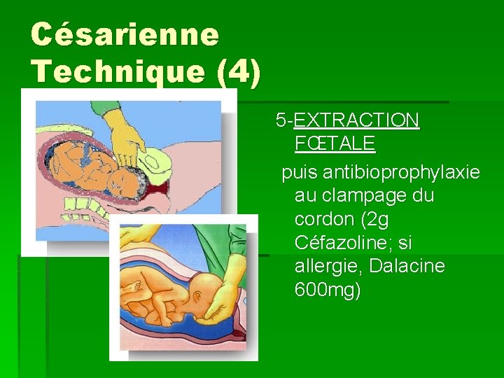 Césarienne Technique (4) 5 -EXTRACTION FŒTALE puis antibioprophylaxie au clampage du cordon (2 g