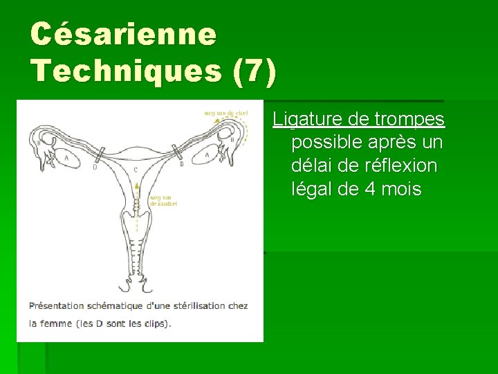 Césarienne Techniques (7) Ligature de trompes possible après un délai de réflexion légal de