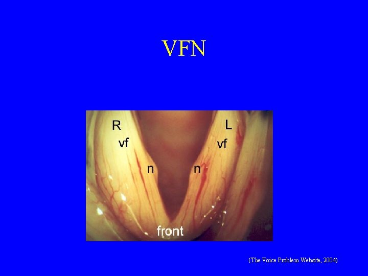 VFN (The Voice Problem Website, 2004) 